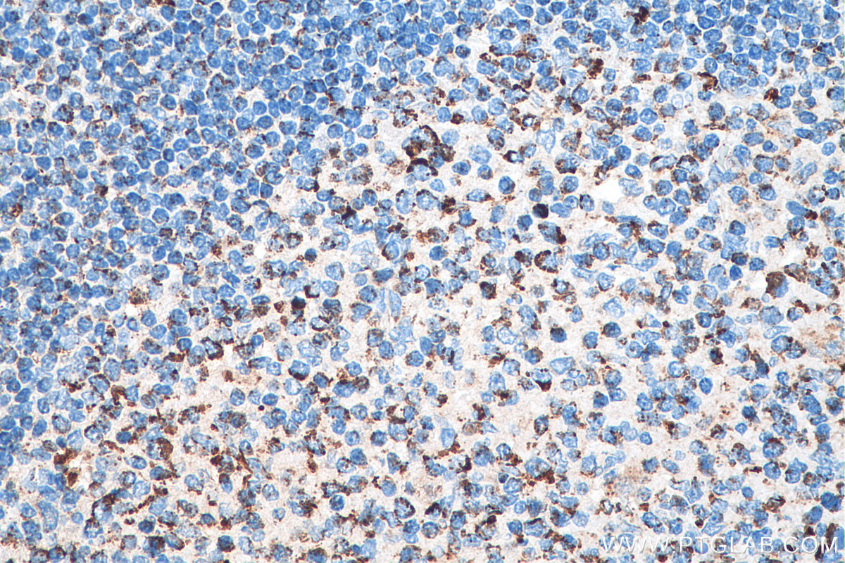 IHC staining of human tonsillitis using 80490-1-RR (same clone as 80490-1-PBS)