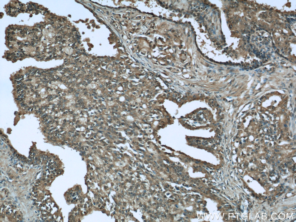 IHC staining of human prostate cancer using 12209-1-AP