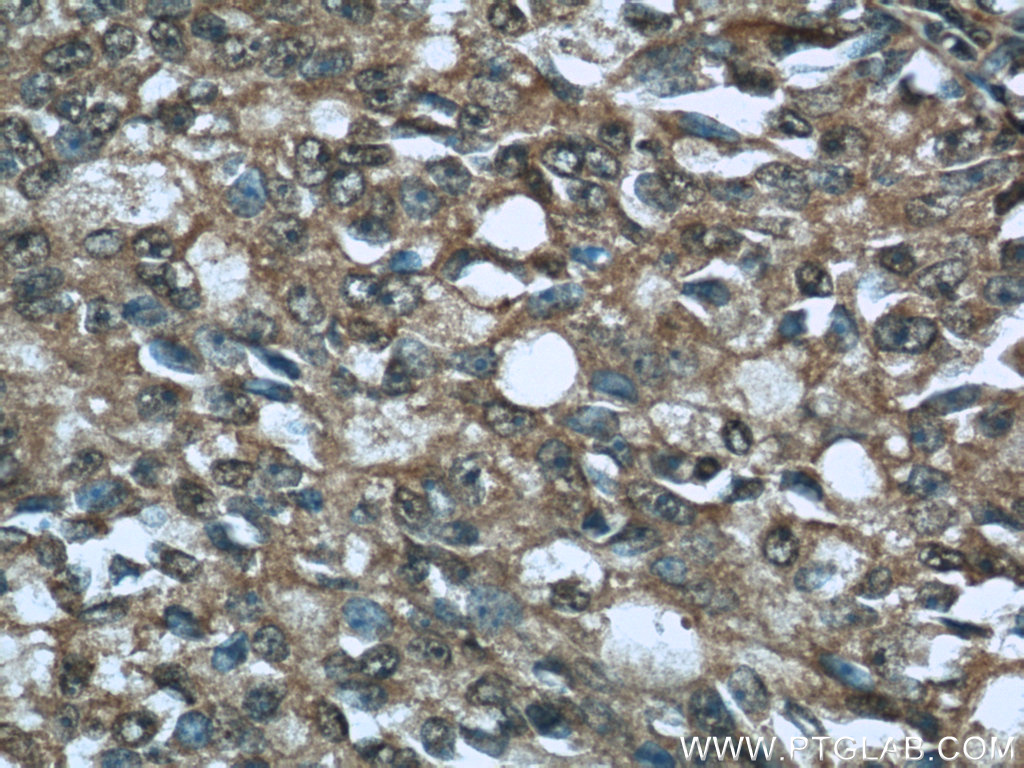 IHC staining of human prostate cancer using 12209-1-AP