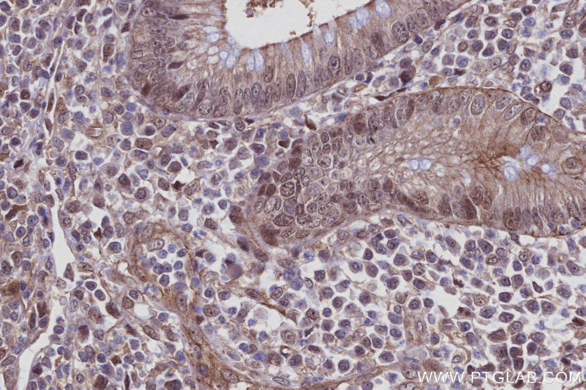 IHC staining of human appendicitis using 27863-1-AP IHC staining of human appendicitis using 27863-1-AP