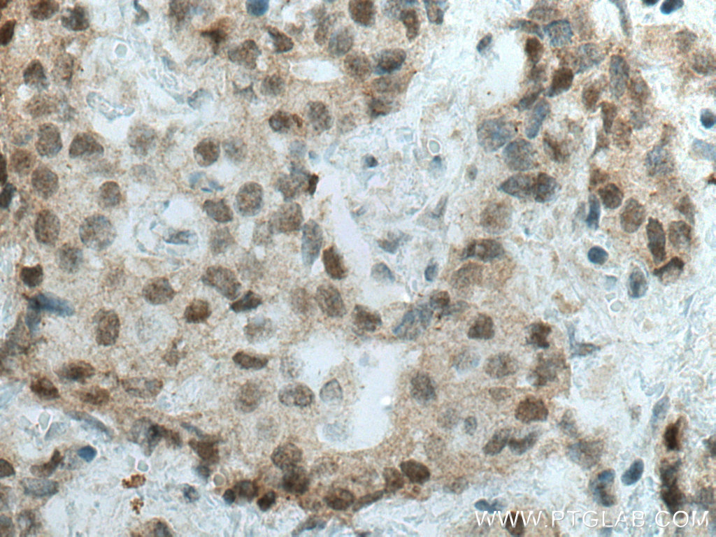 IHC staining of human breast cancer using 26109-1-AP