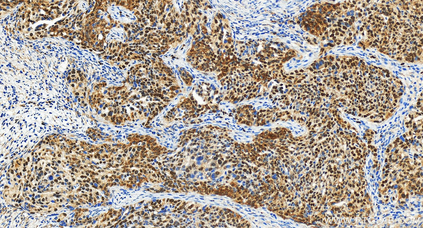 IHC staining of human ovary cancer using 23746-1-AP