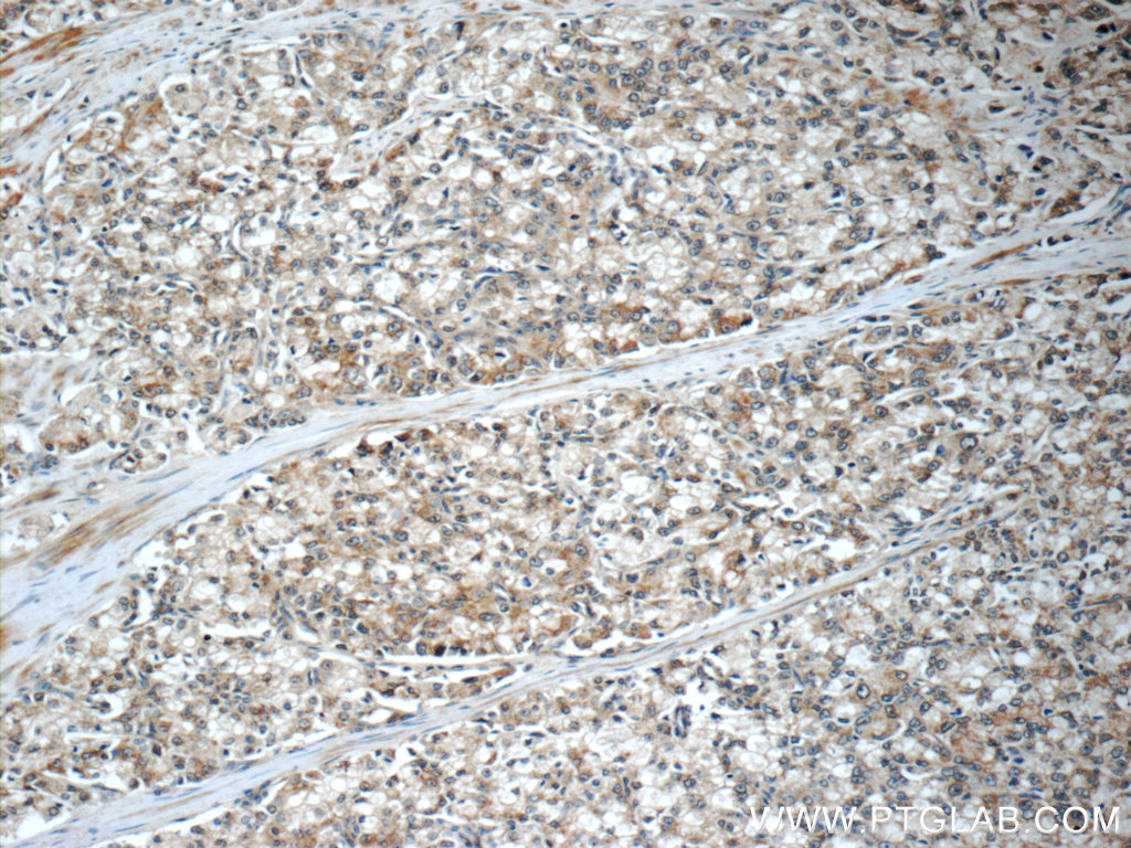 IHC staining of human prostate cancer using 16040-1-AP