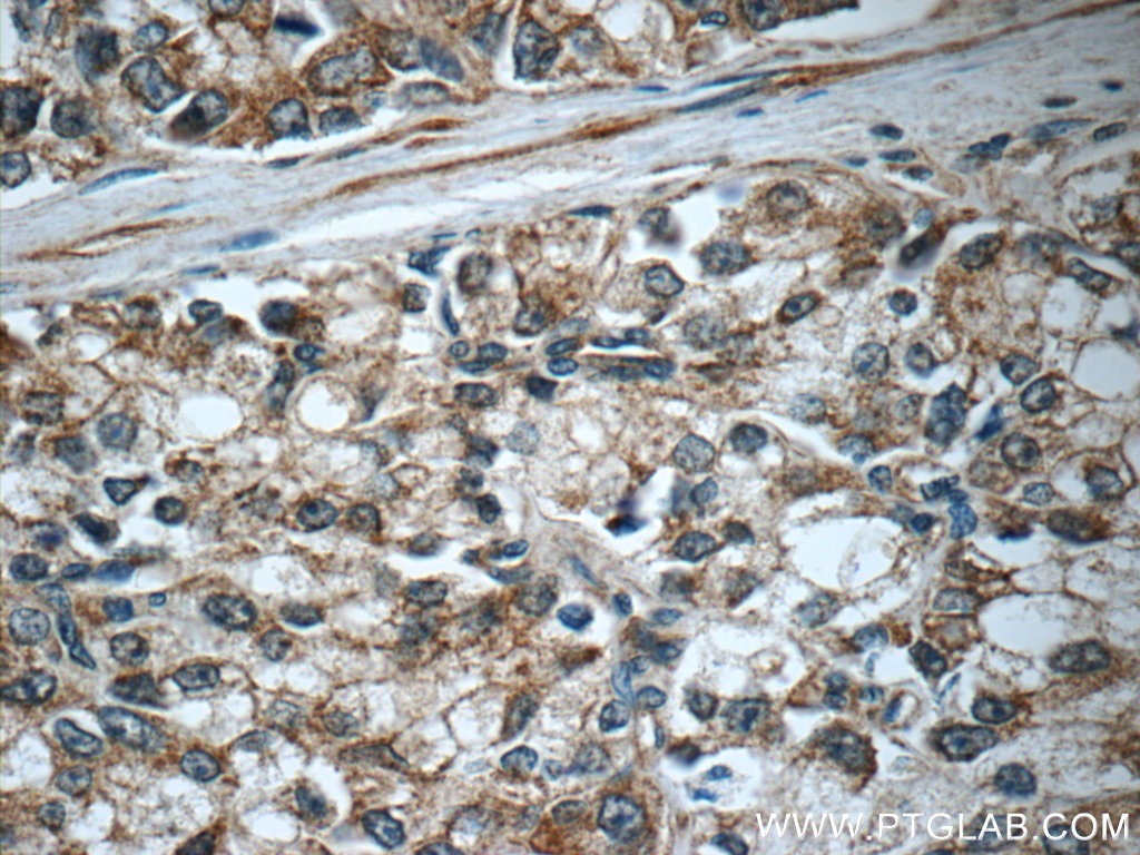IHC staining of human prostate cancer using 16040-1-AP