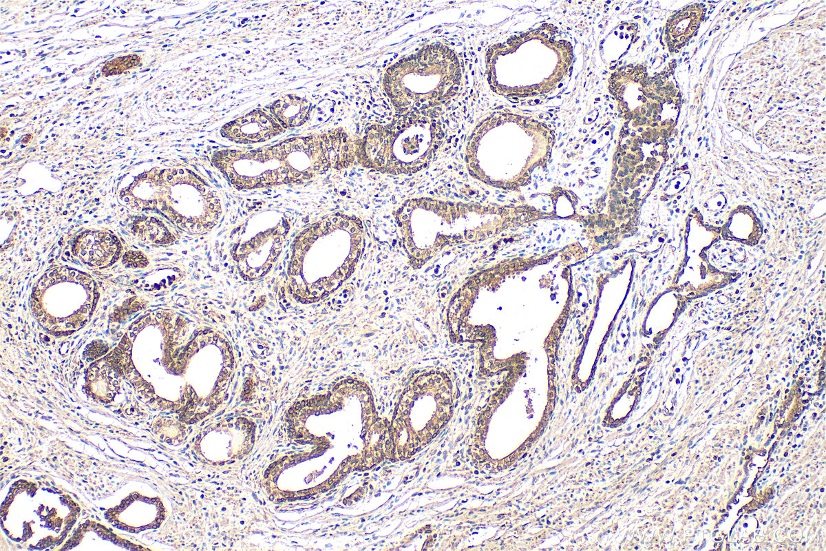 IHC staining of human prostate cancer using 67464-1-Ig