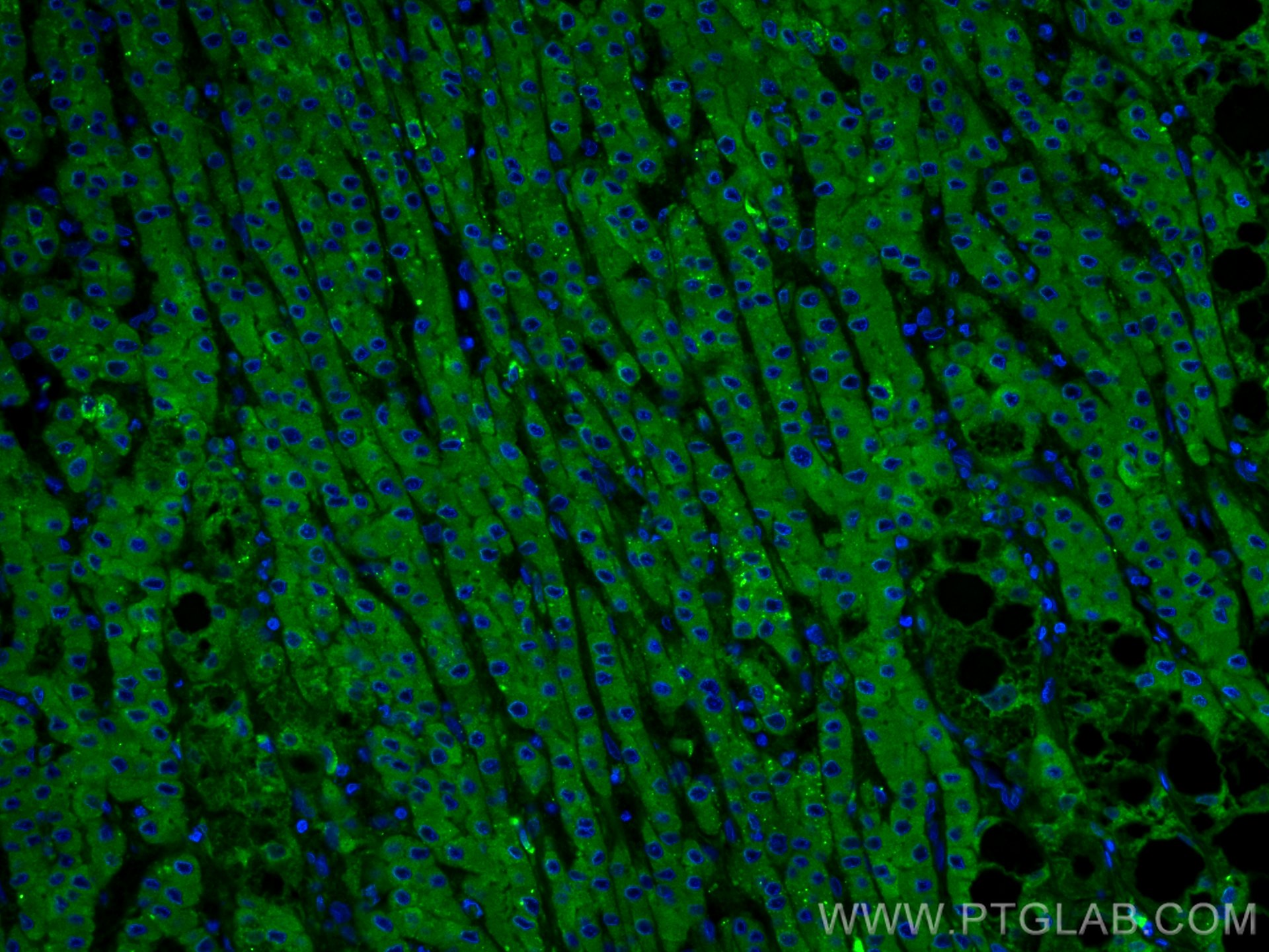 IF Staining of human liver cancer using 21337-1-AP