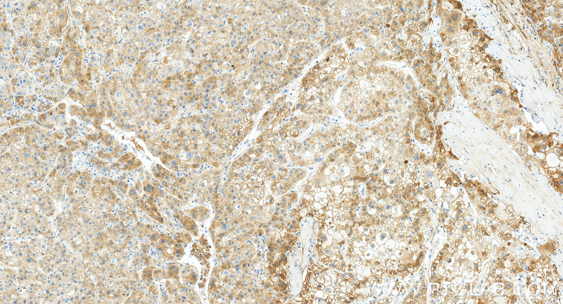 IHC staining of human liver cancer using 87386-1-RR (same clone as 87386-1-PBS)