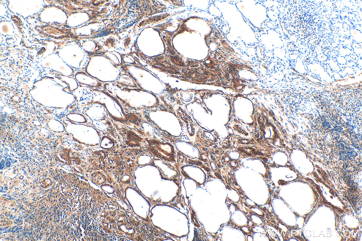 IHC staining of human thyroid cancer using 84975-1-RR