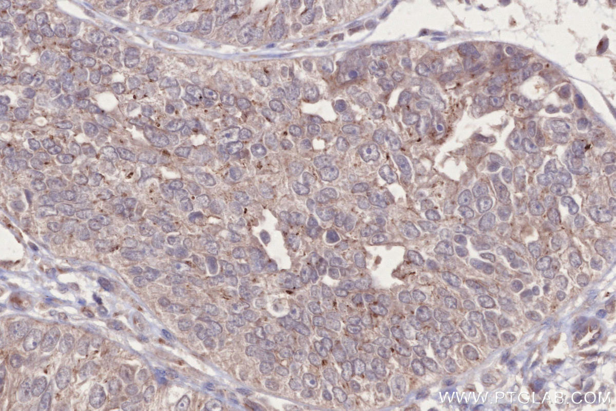 IHC staining of human ovary cancer using 27145-1-AP