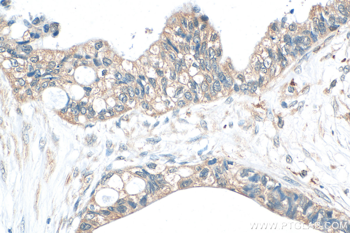 Immunohistochemical analysis of paraffin-embedded human urothelial carcinoma tissue slide using 18991-1-AP (HAUS3 antibody) at dilution of 1:200 (under 40x lens). Heat mediated antigen retrieval with Tris-EDTA buffer (pH 9.0). IHC staining of human urothelial carcinoma using 18991-1-AP