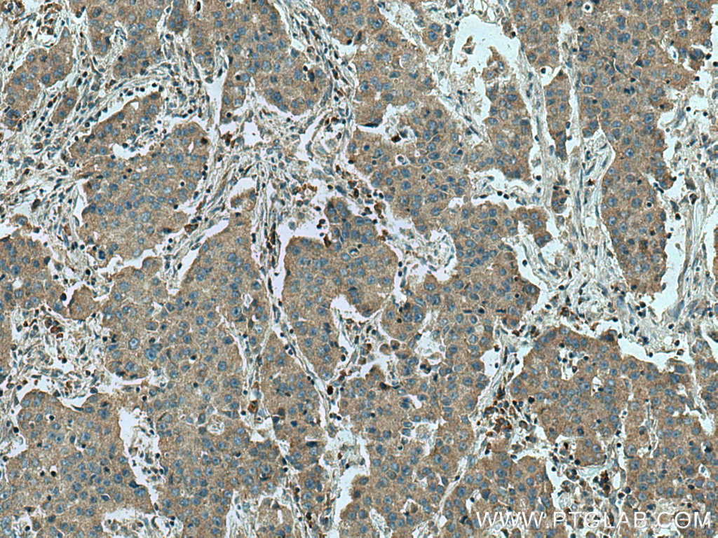 IHC staining of human breast cancer using 24355-1-AP