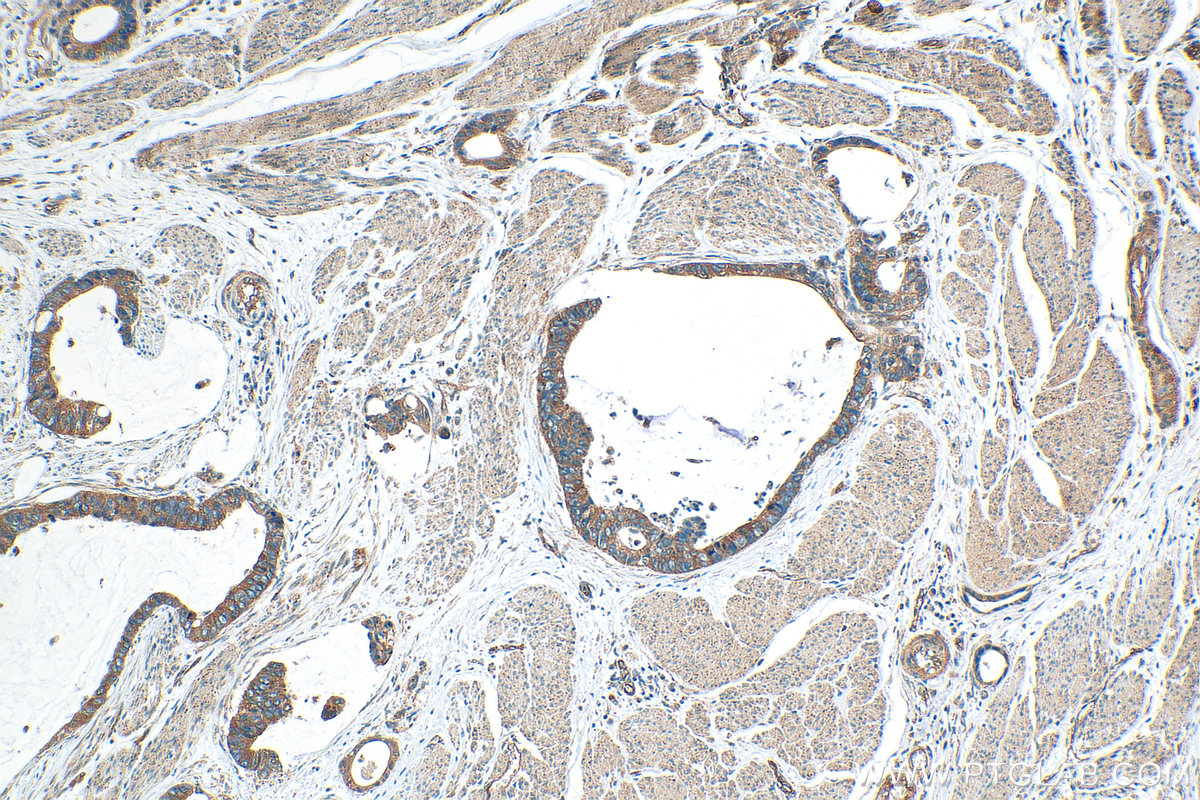 IHC staining of human urothelial carcinoma using 20880-1-AP