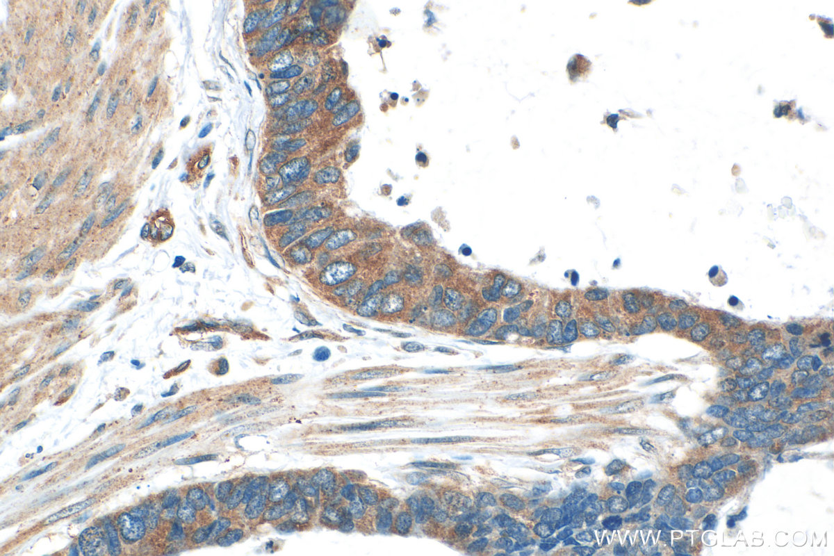 IHC staining of human urothelial carcinoma using 20880-1-AP