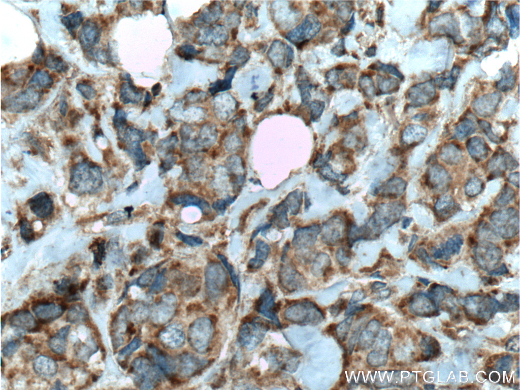 IHC staining of human breast cancer using 24214-1-AP