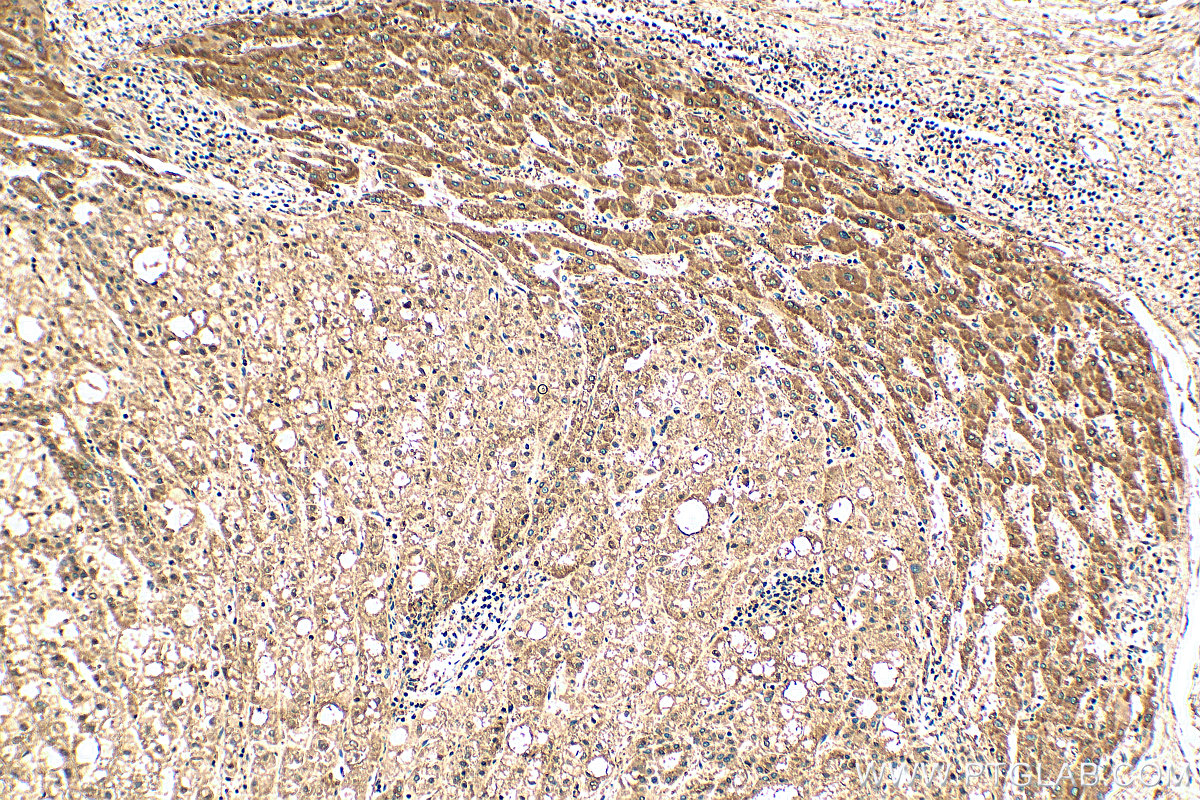 IHC staining of human liver cancer using 27200-1-AP