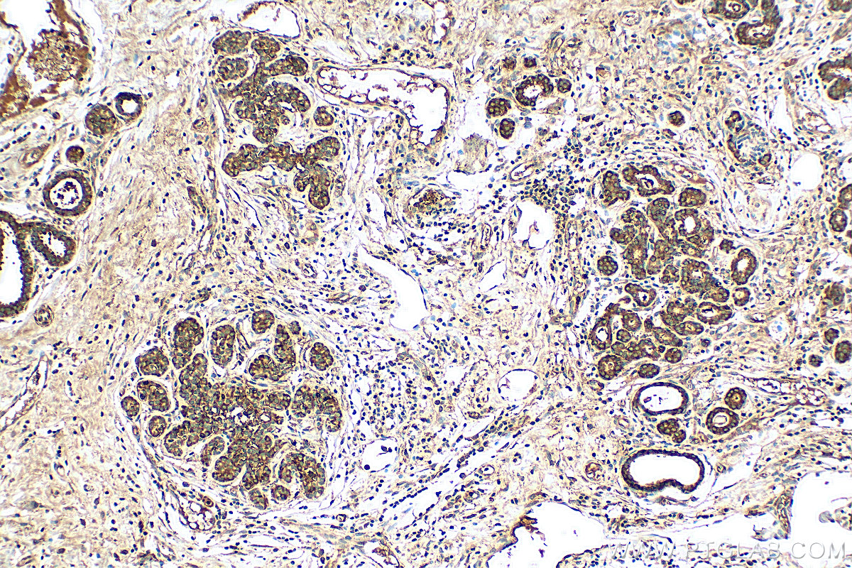 IHC staining of human breast cancer using 27200-1-AP