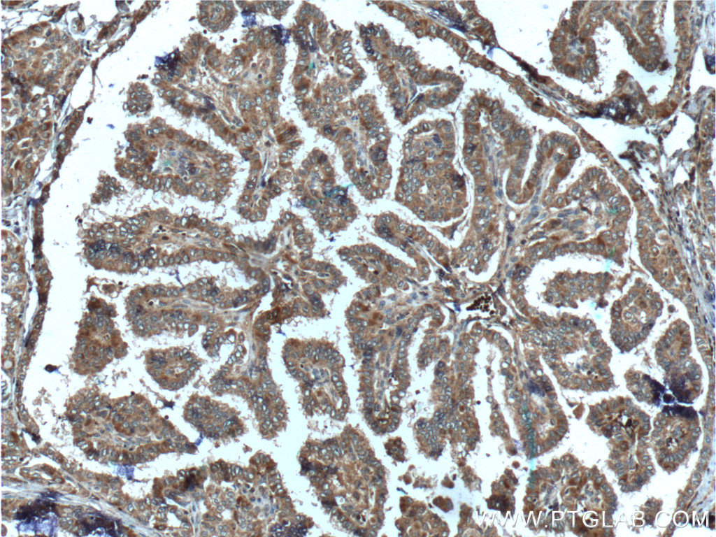 IHC staining of human thyroid cancer using 26279-1-AP