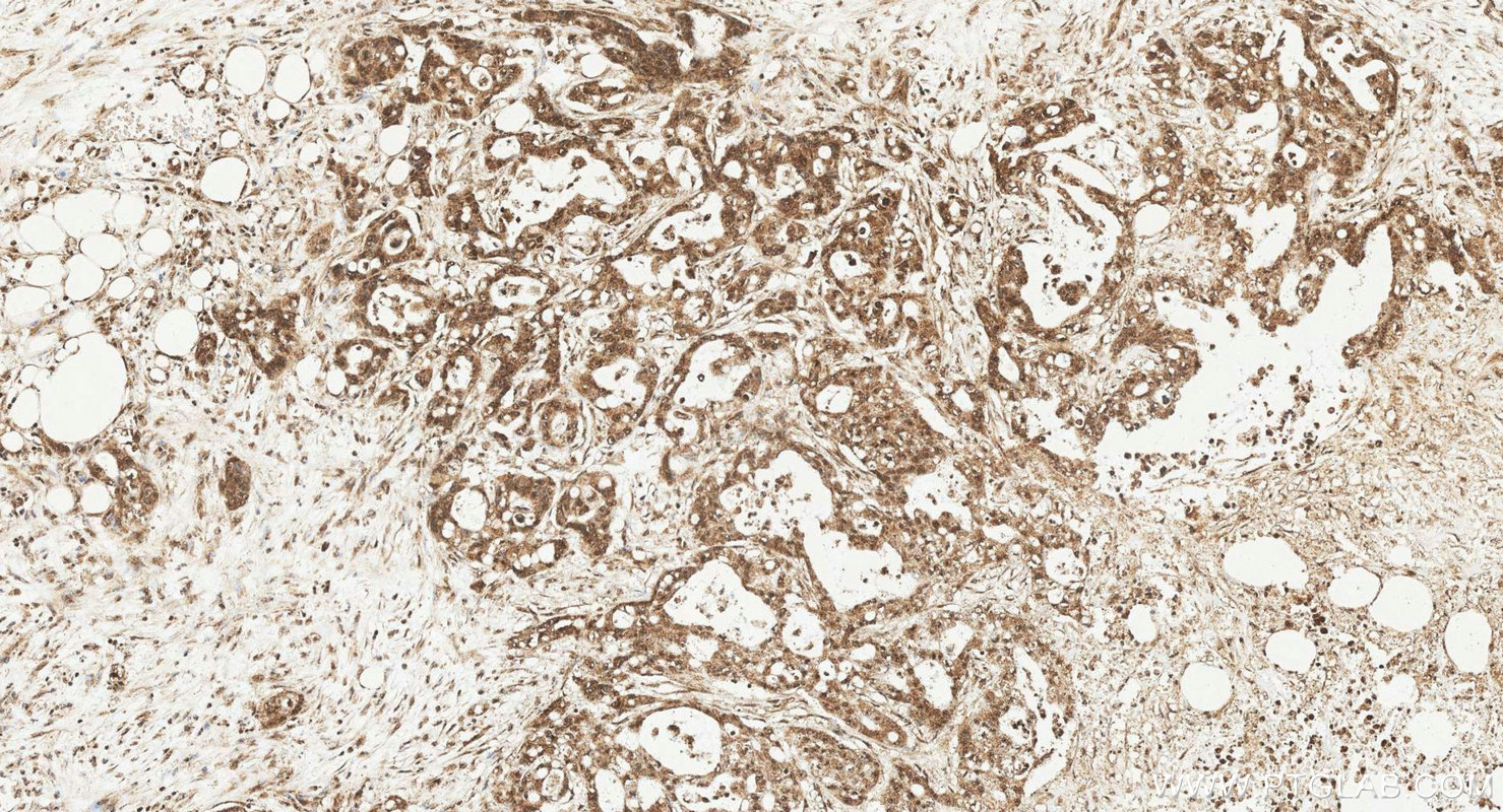 IHC staining of human colon cancer using 20779-1-AP IHC staining of human colon cancer using 20779-1-AP