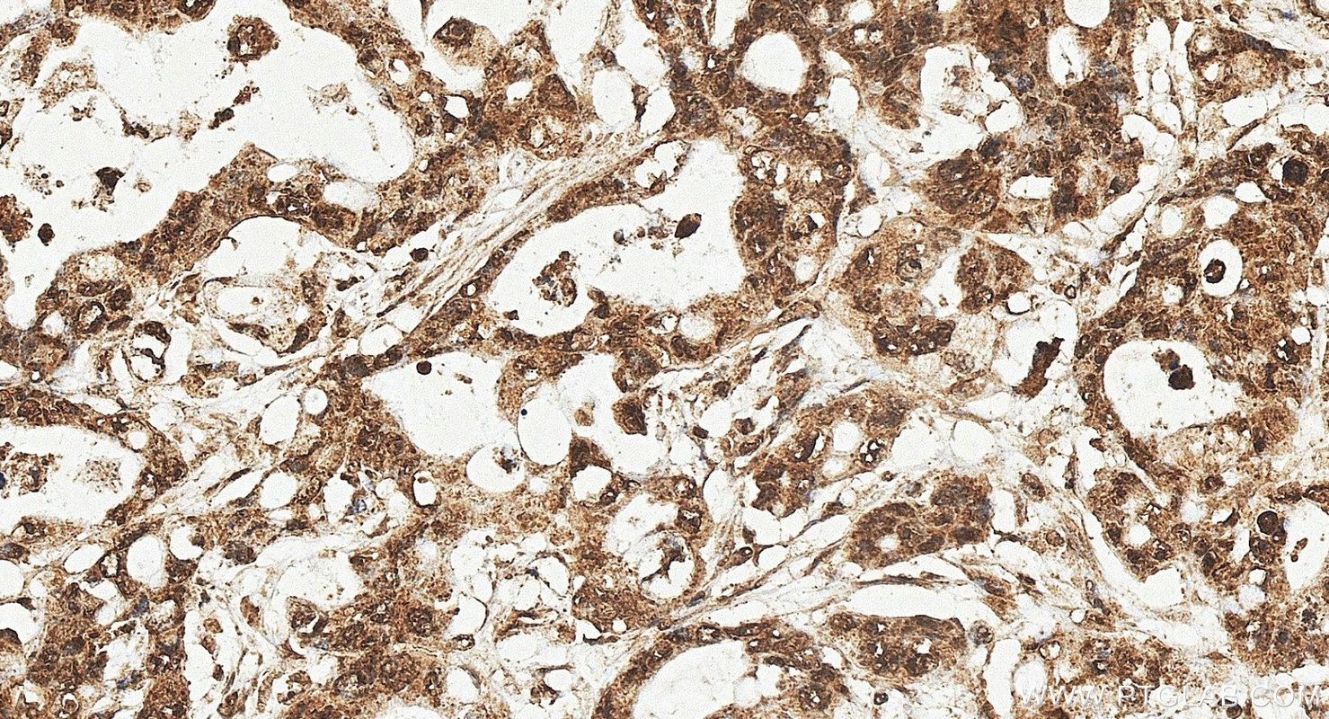 IHC staining of human colon cancer using 20779-1-AP IHC staining of human colon cancer using 20779-1-AP