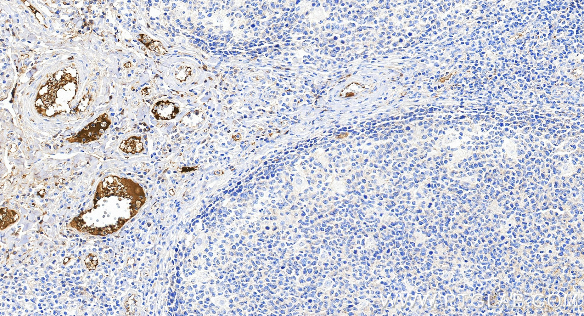 IHC staining of human tonsillitis using 84890-4-RR IHC staining of human tonsillitis using 84890-4-RR