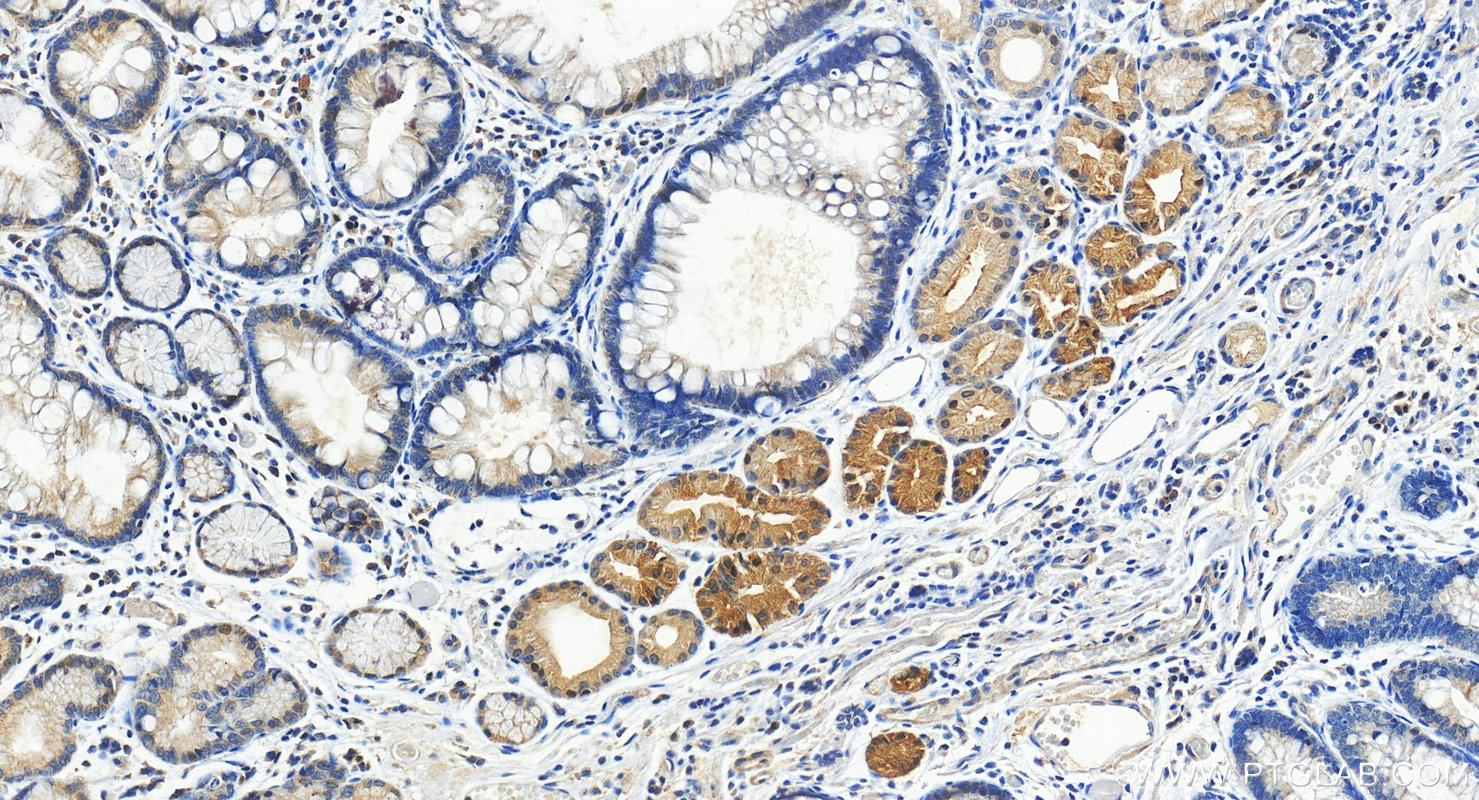 Immunohistochemical analysis of paraffin-embedded human stomach cancer tissue slide using 27028-1-AP (ERCC6L2 antibody) at dilution of 1:1000 (under 20x lens). Heat mediated antigen retrieval with Tris-EDTA buffer (pH 9.0). IHC staining of human stomach cancer using 27028-1-AP