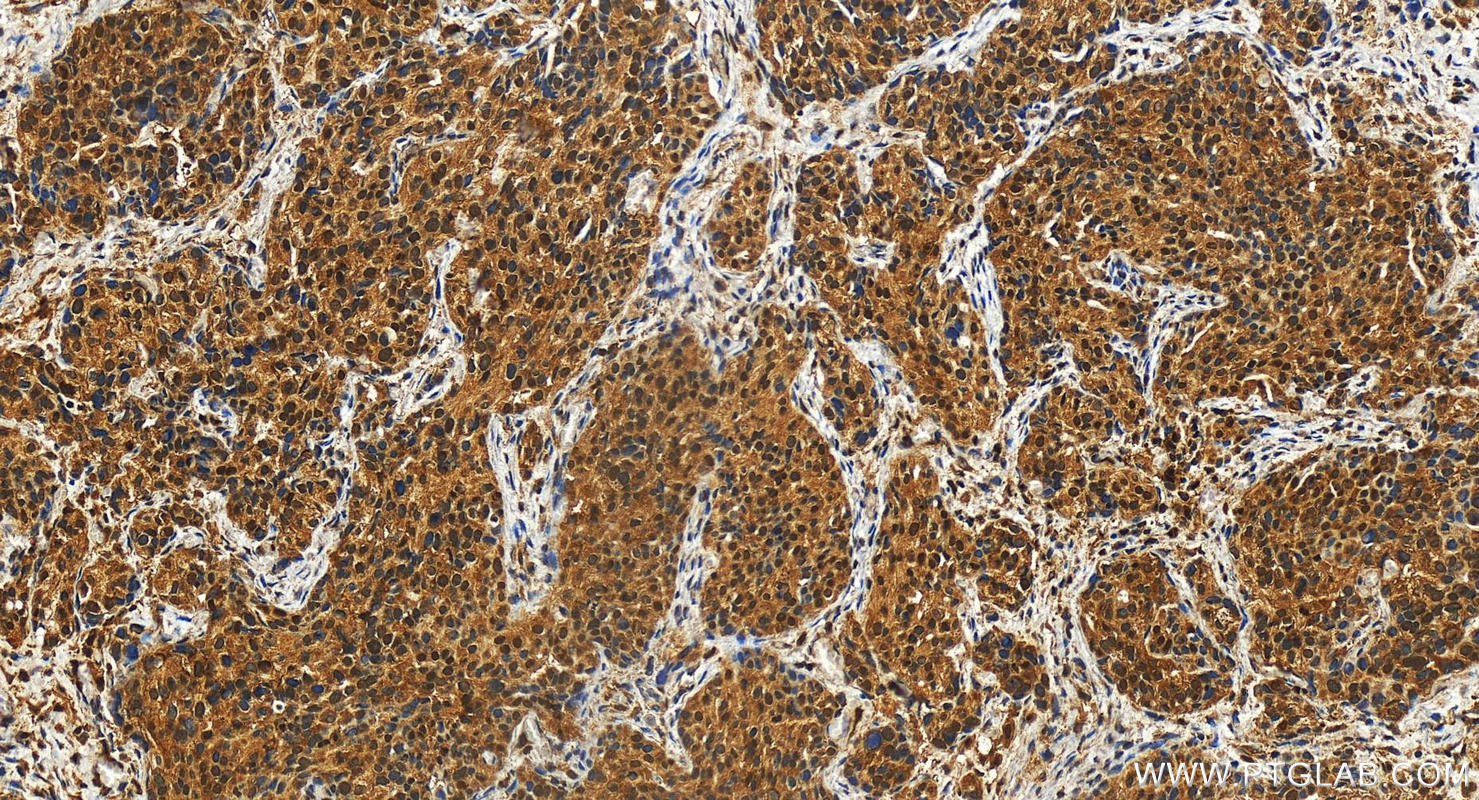 IHC staining of human ovary cancer using 27134-1-AP