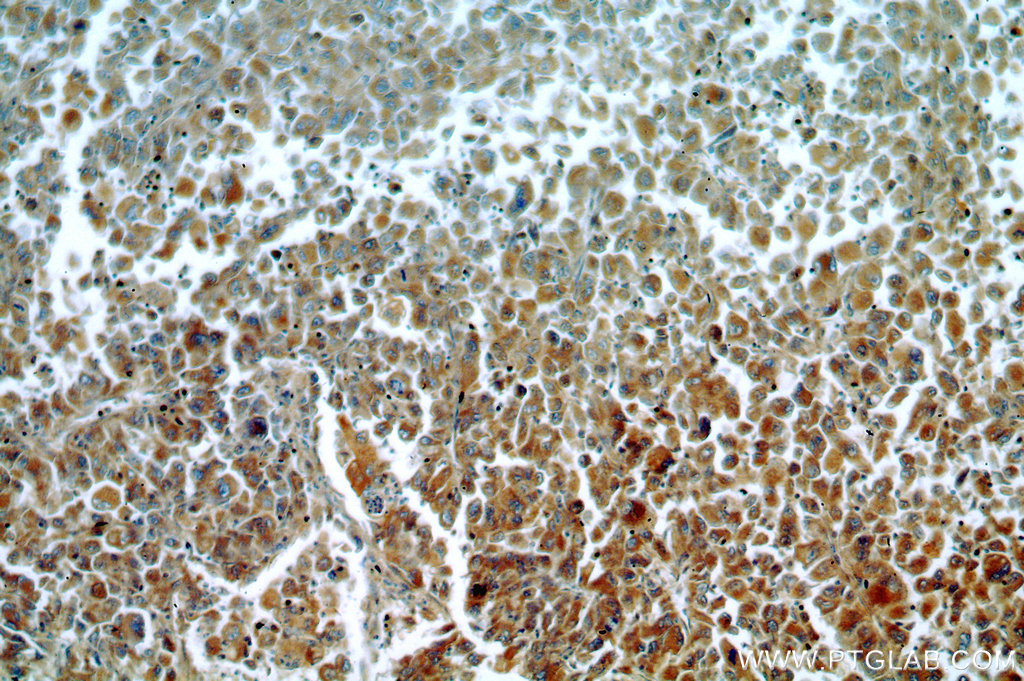 IHC staining of human lung cancer using 20475-1-AP