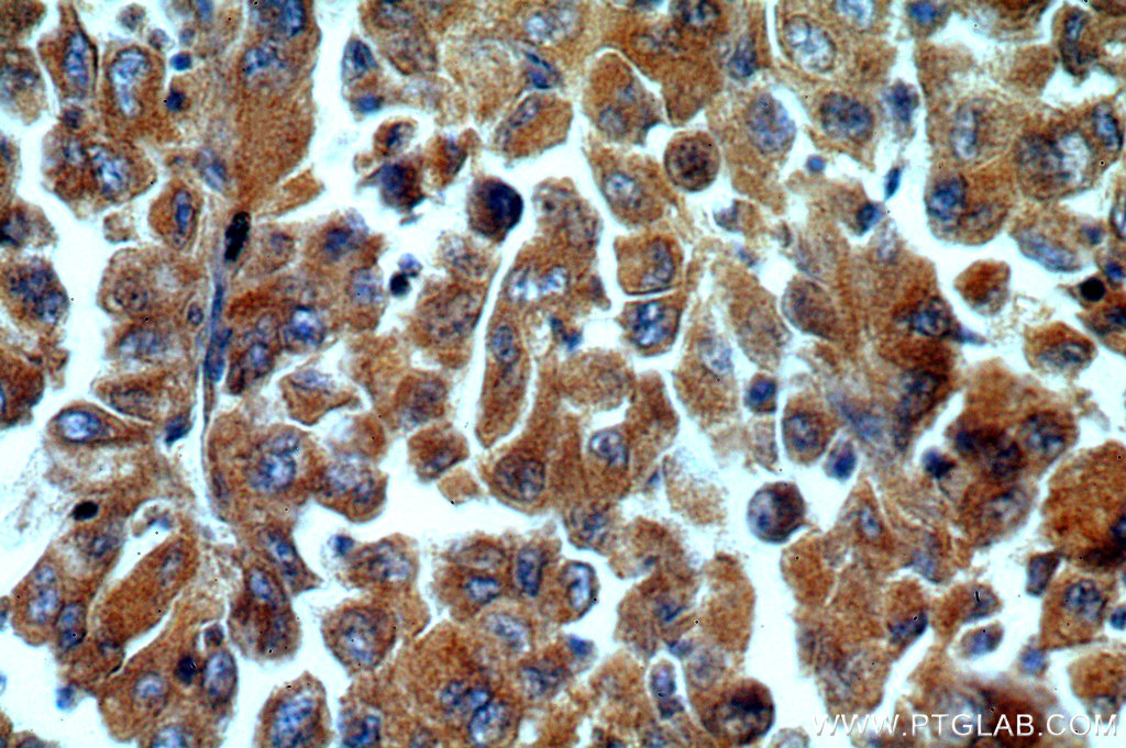 IHC staining of human lung cancer using 20475-1-AP