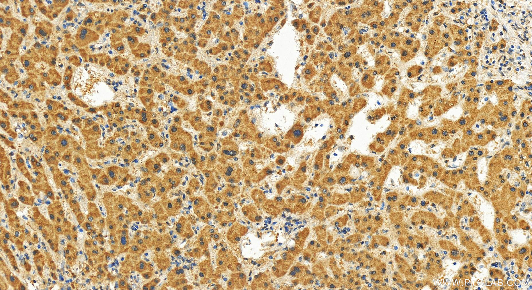IHC staining of human intrahepatic cholangiocarcinoma using 27797-1-AP