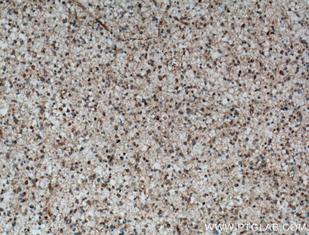 IHC staining of human gliomas using 22637-1-AP