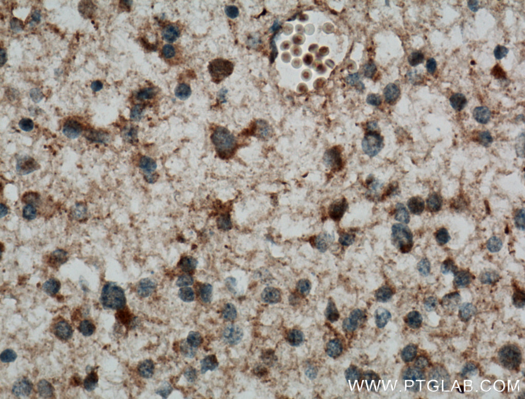 IHC staining of human gliomas using 22637-1-AP