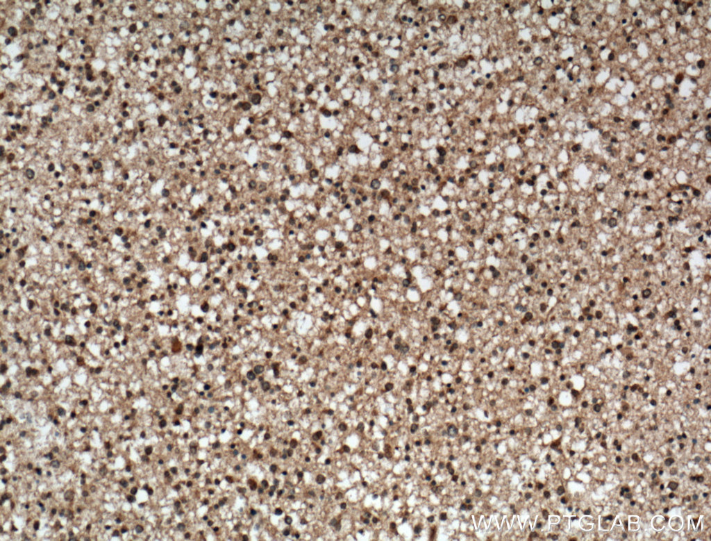 IHC staining of human gliomas using 66140-1-Ig