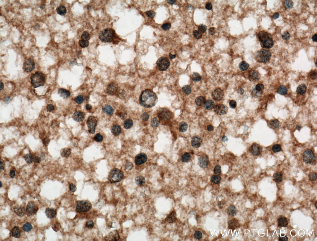 IHC staining of human gliomas using 66140-1-Ig