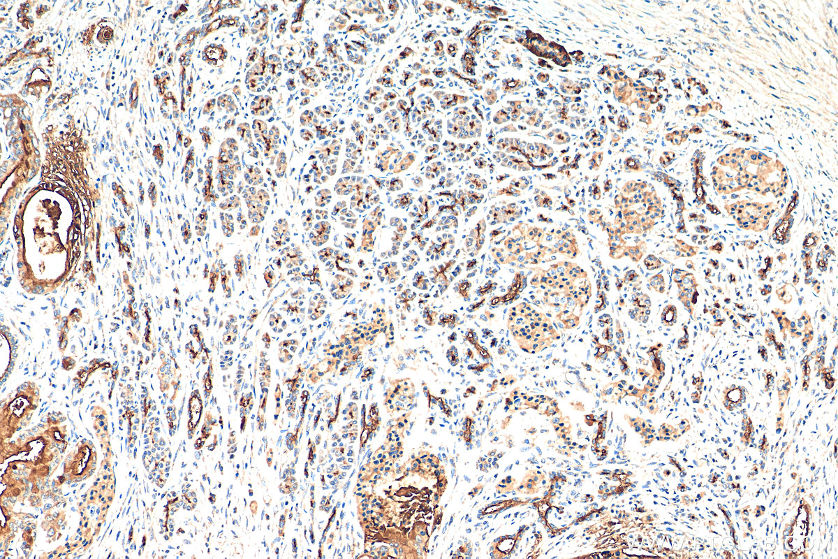 IHC staining of human pancreas cancer using 23614-1-AP