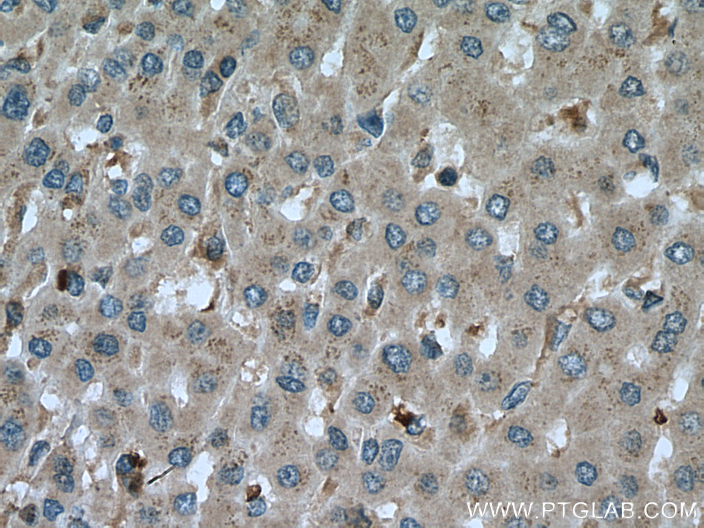 IHC staining of human liver cancer using 13670-1-AP