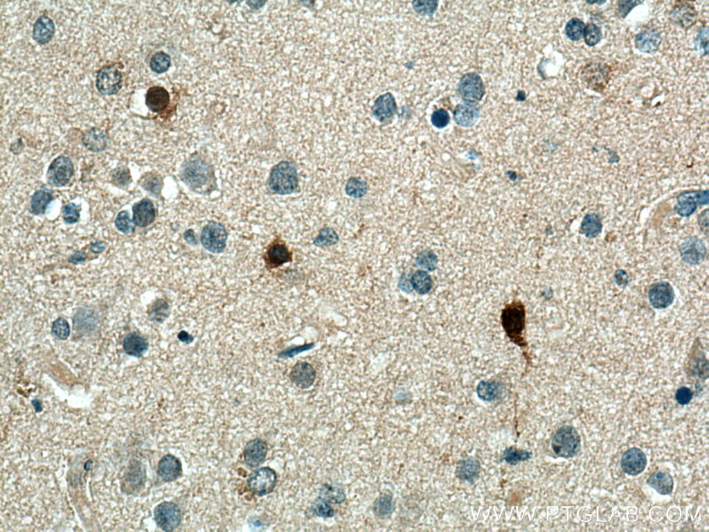 IHC staining of human gliomas using 12391-1-AP