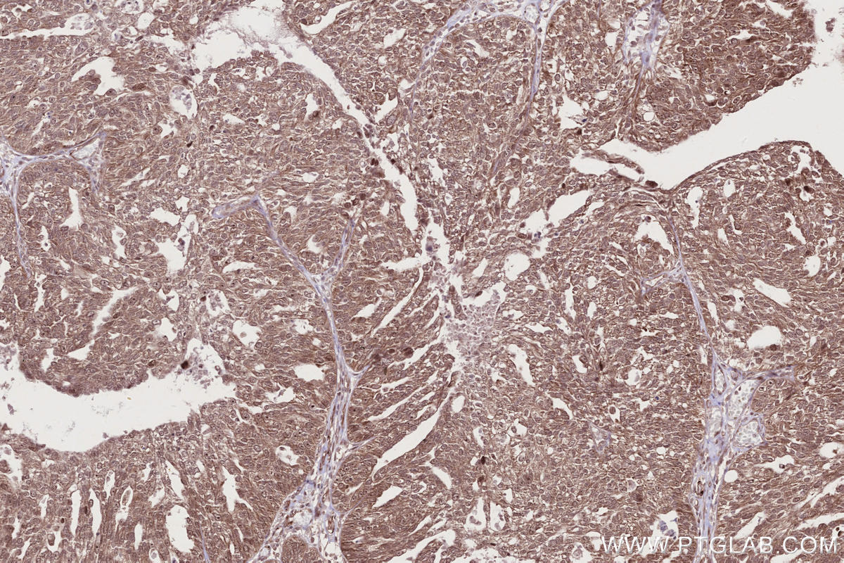 IHC staining of human ovary cancer using 13464-1-AP