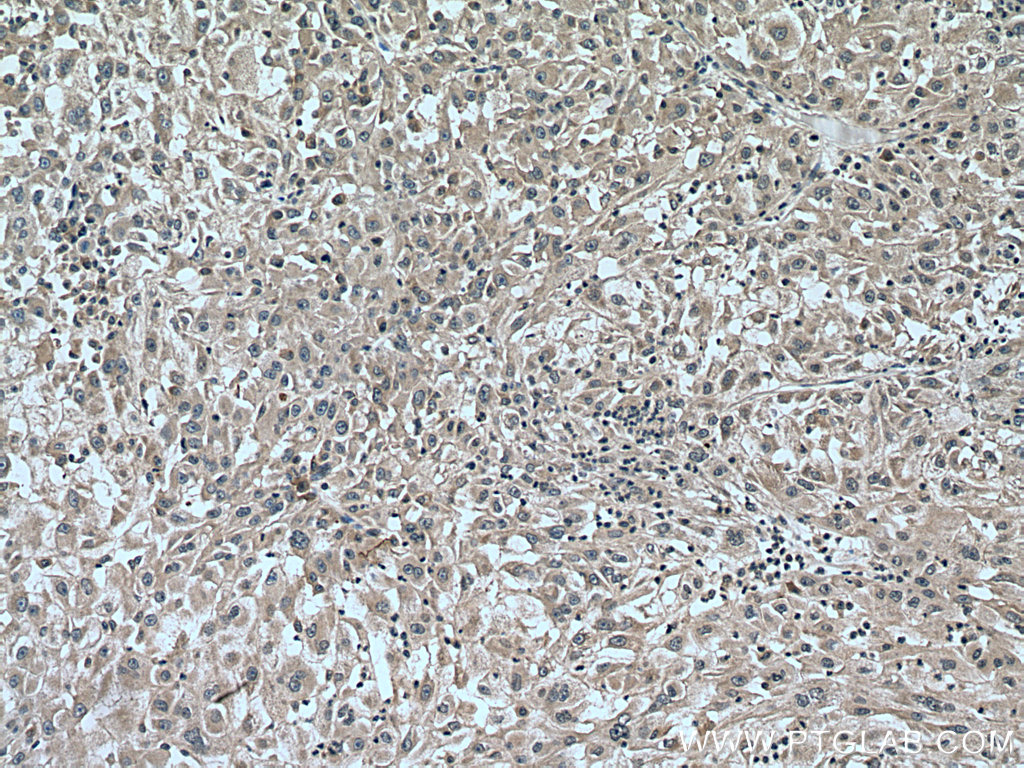 IHC staining of human liver cancer using 16617-1-AP (same clone as 16617-1-PBS)