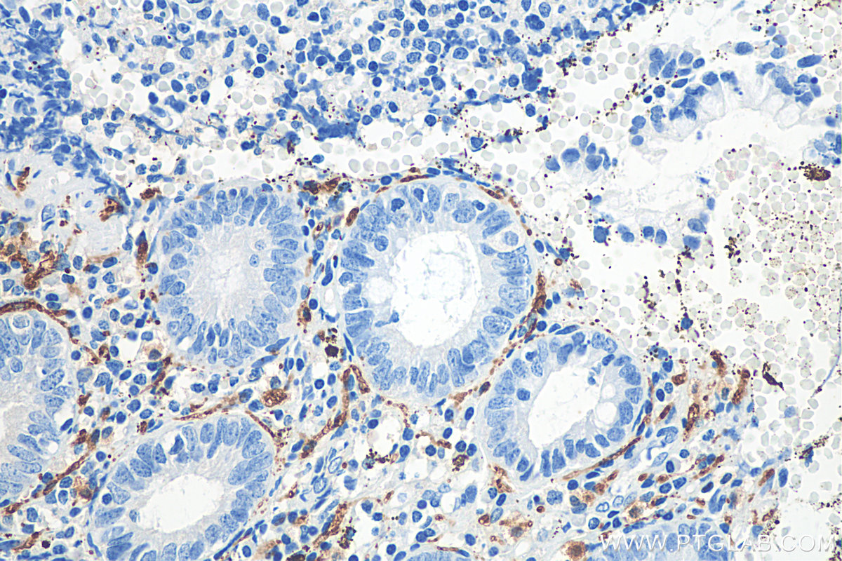 IHC staining of human appendicitis using 12278-1-AP