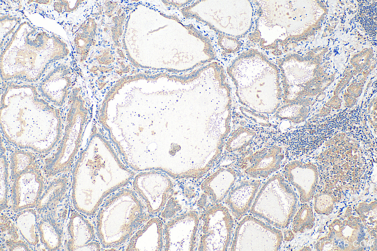 IHC staining of human thyroid cancer using 68774-1-Ig (same clone as 68774-1-PBS)
