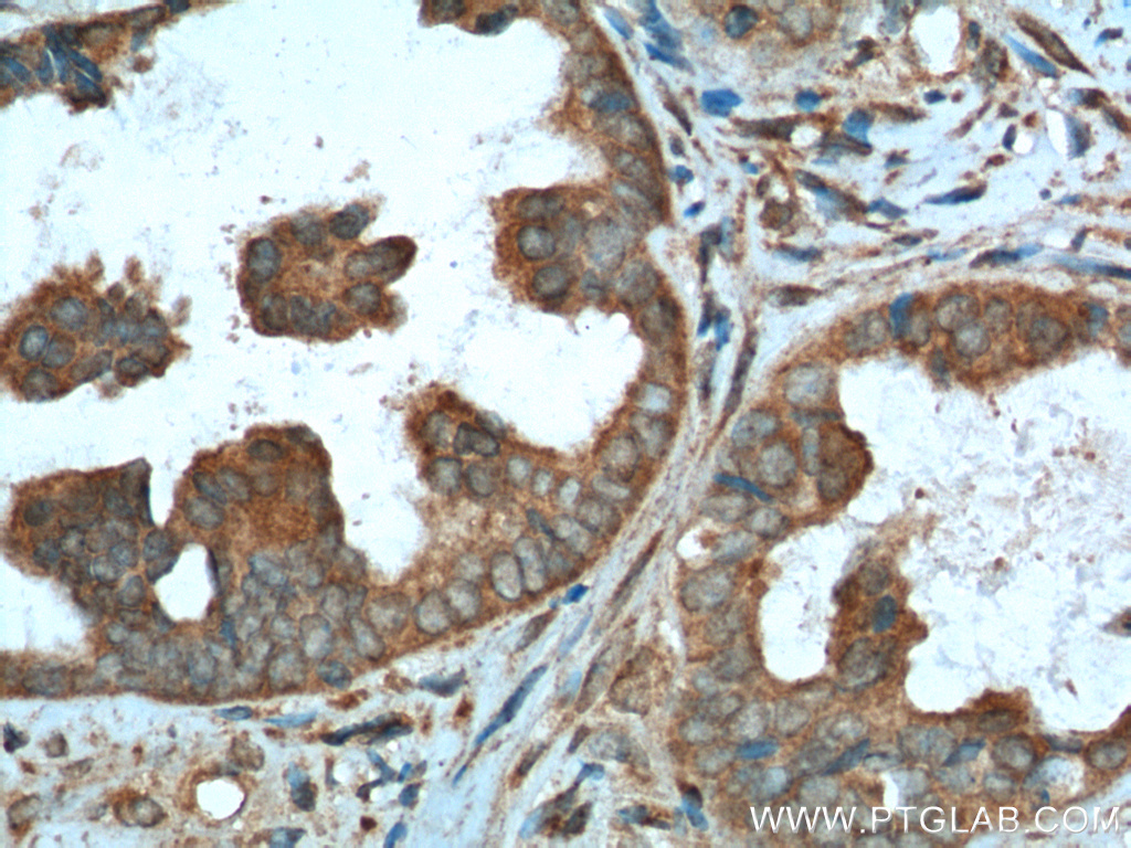 IHC staining of human ovary tumor using 12229-1-AP
