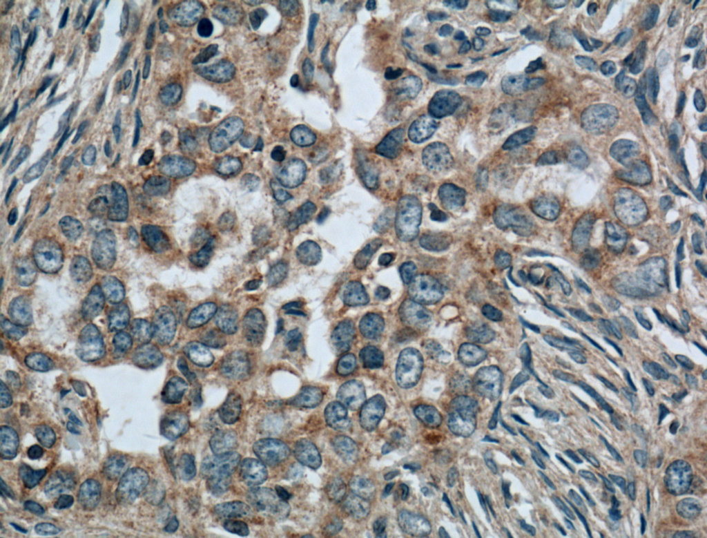 IHC staining of human ovary tumor using 66401-1-Ig (same clone as 66401-1-PBS)