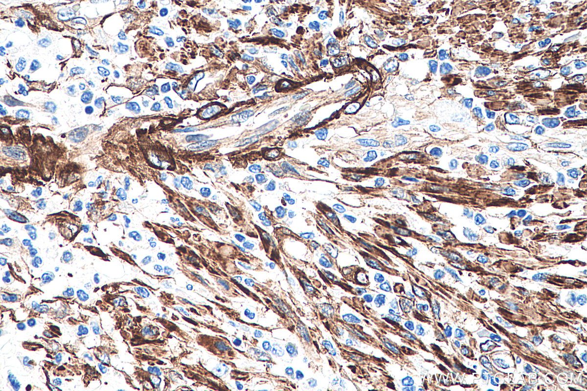 IHC staining of human colon cancer using 66693-1-Ig