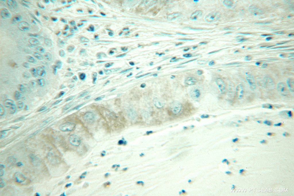 IHC staining of human lung cancer using 10303-1-AP