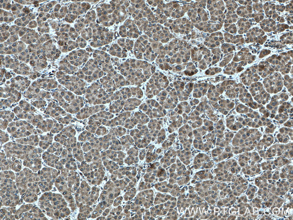 IHC staining of human liver cancer using 17275-1-AP