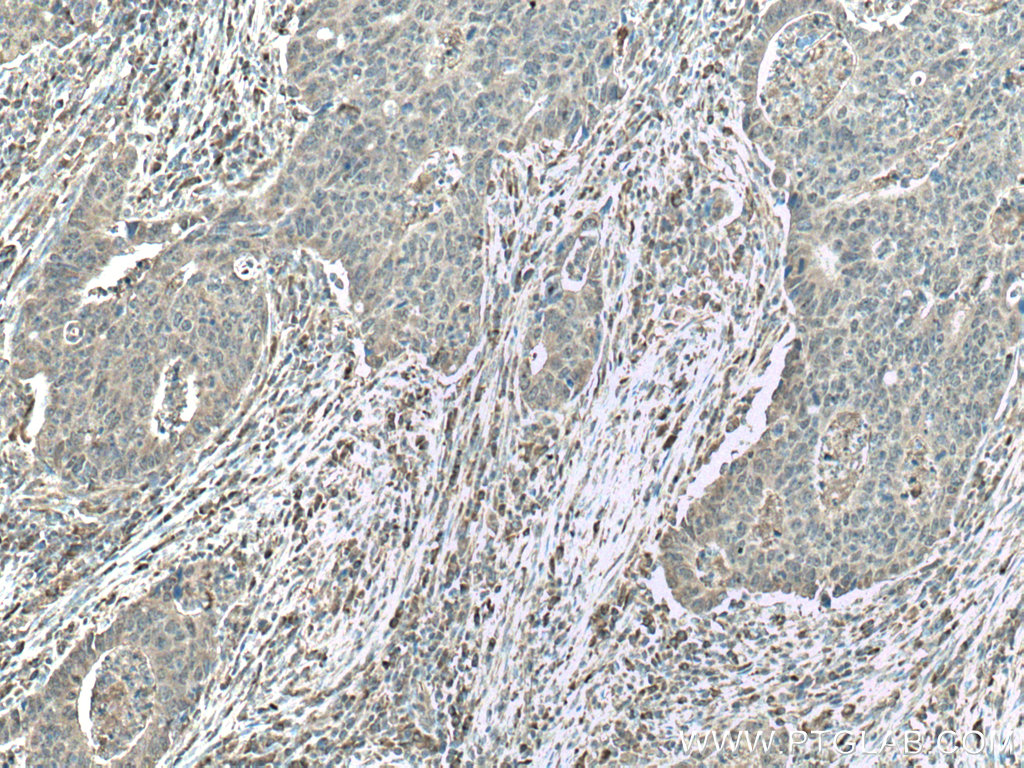 IHC staining of human colon cancer using 24312-1-AP