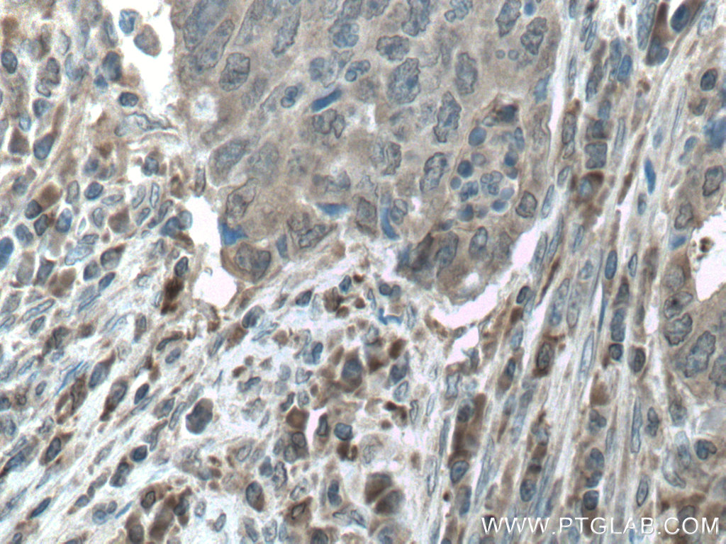 IHC staining of human colon cancer using 24312-1-AP