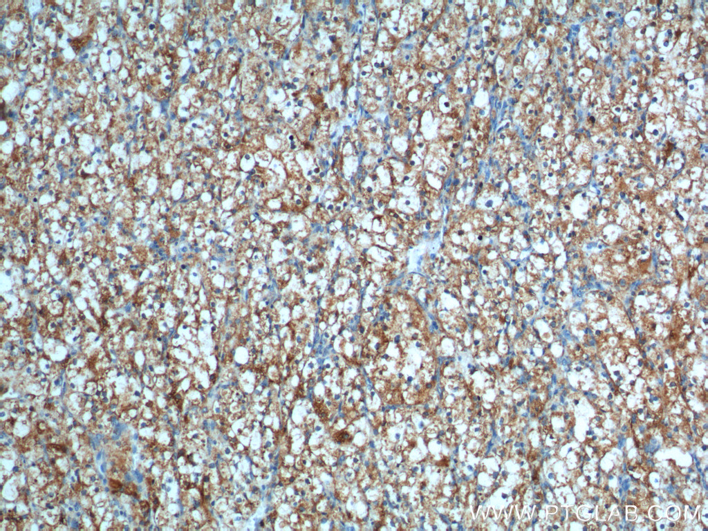 IHC staining of human renal cell carcinoma using 13730-1-AP
