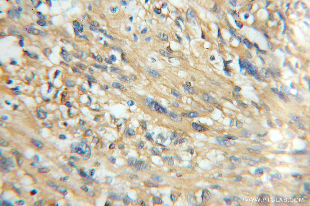 IHC staining of human gliomas using 11533-1-AP
