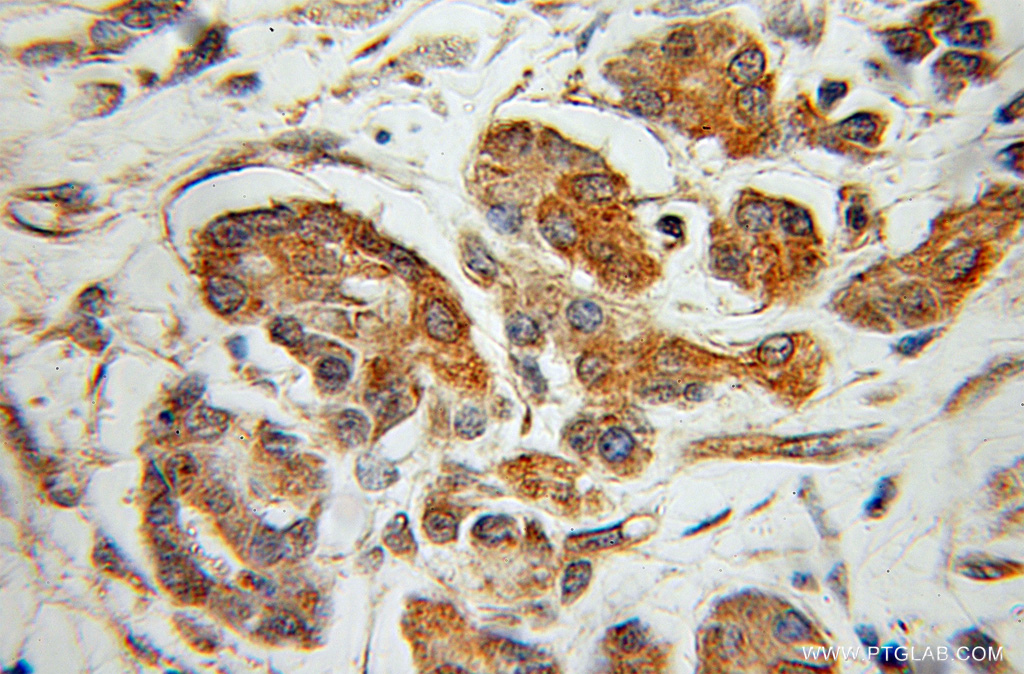 IHC staining of human pancreas cancer using 12666-2-AP